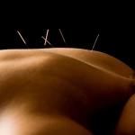 acupuntura
